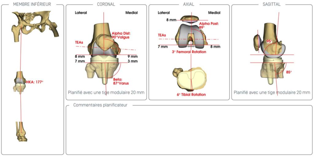 Prothèse totale de genou sur mesure avec planification 3D par scanner