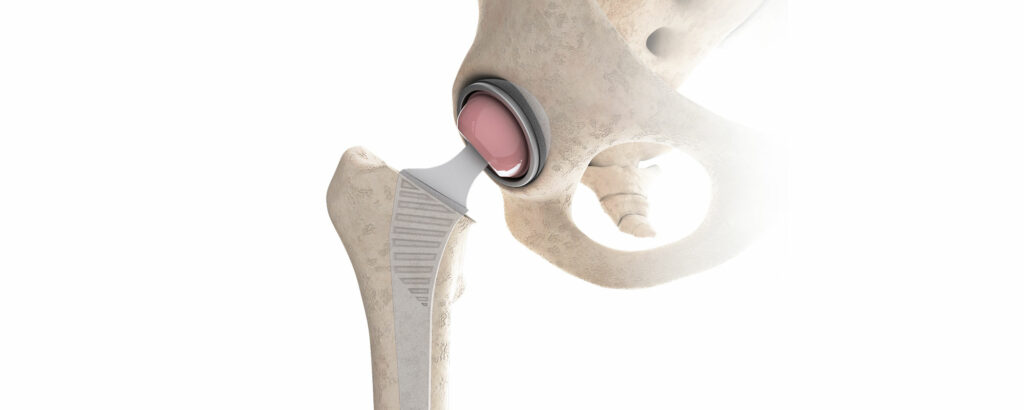 Coxarthrose